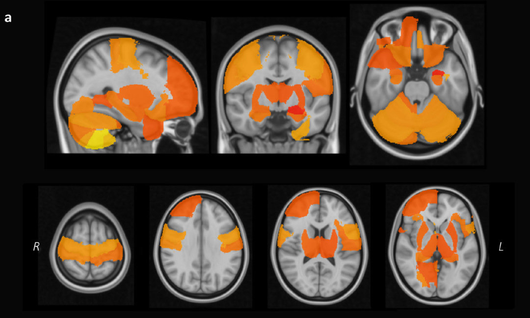 睡眠6~8小時的人大腦體積更大
